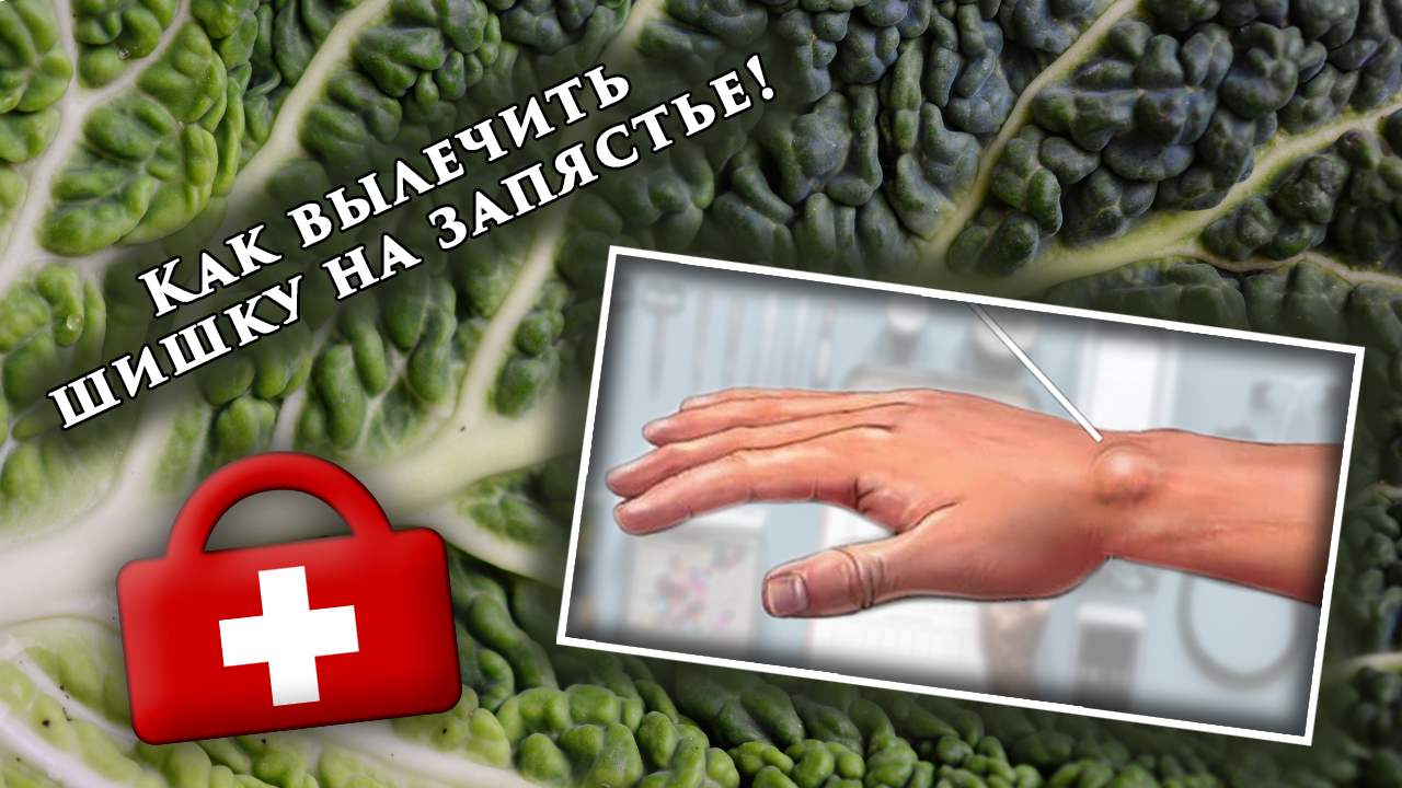 Изображение к статье: как вылечить шишку на запястье руки (капустный лист, фото шишки, мед.сумка)